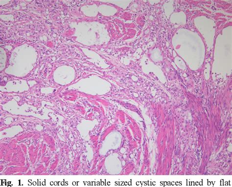 Table 1 From Adenomatoid Tumors Of Female Genital Tracts An Analysis