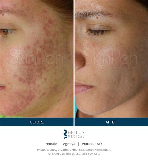 Mercer Island Dermatology Microneedling