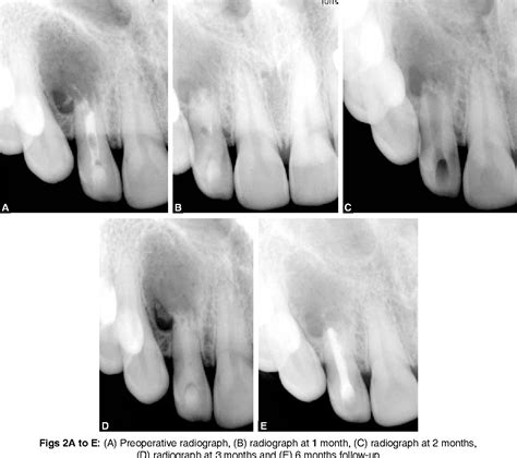 Figure From Nonsurgical Management Of Large Periapical Lesion In