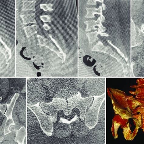 Ct Scan Shows A Complex Sacral Fracture With Compression And Download Scientific Diagram