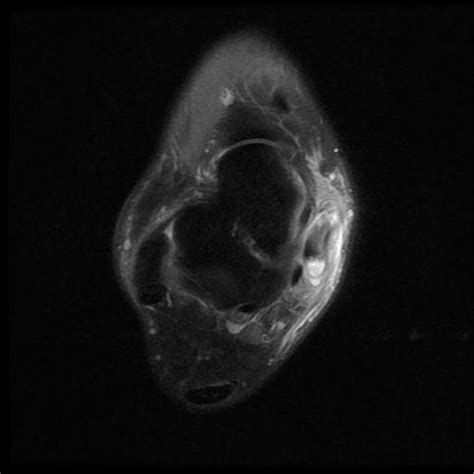 Mri Musculo Skeletal Section Tenosynovitis Of Tibialis Posterior | Sexiz Pix