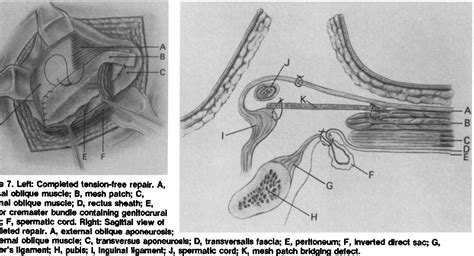 Figure 7 From The Tension Free Hernioplasty Semantic Scholar