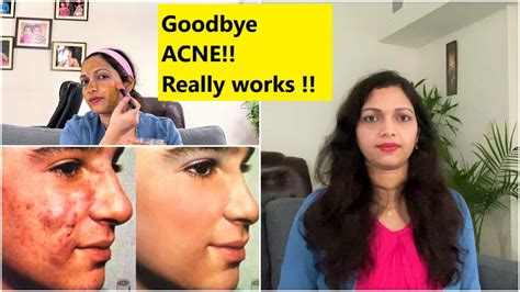 How To Get Rid Of Acne Pimple मुंहासे फुंसी से कैसे छुटकारा पाए