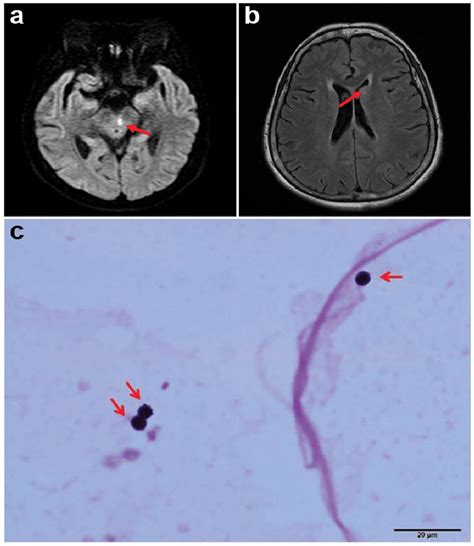 1a Diffusion Weighted Magnetic Resonance Image Showing An Acute Download Scientific Diagram