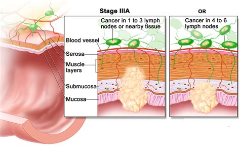 Colon Cancer Causes, Signs, Symptoms, Stages, Screening & Treatment