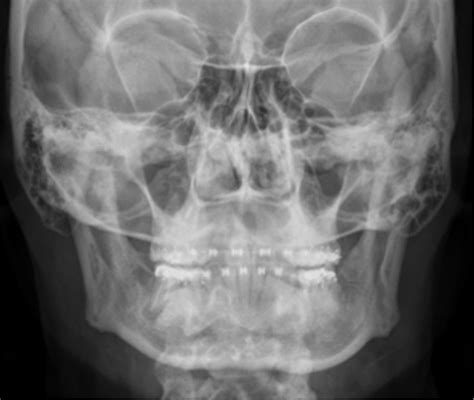 RADR 2331 MANDIBLE PA PROJECTION MANDIBULAR RAMI Diagram Quizlet