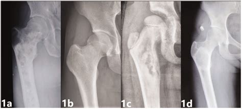 Anatomic Classification Of Fibrous Dysplasia Of The Proximal Femur