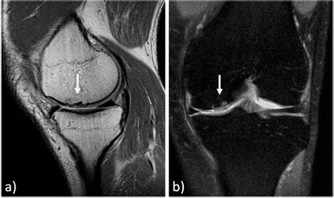 MRI evaluation at 11 years' follow-up of a medial femoral condyle ...