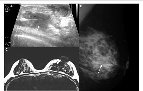 Figure 1 From Dermis Retained Breast Dermo Glandular Flap A New Surgical Approach For