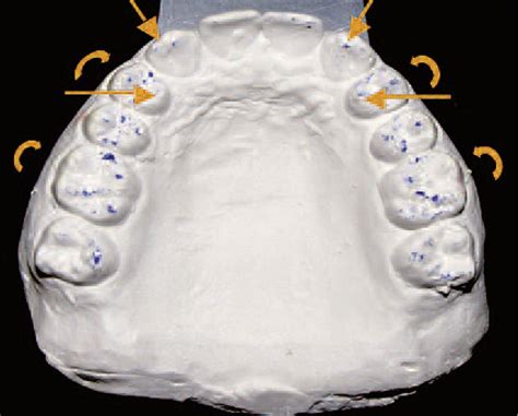 The Points Of Occlusal Contact Objectify Premolar And Canine Areas