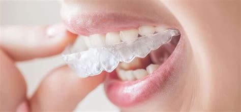 Cuánto tiempo al día hay que llevar Invisalign Ferrus Bratos