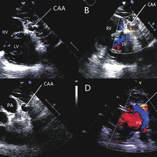 Figure A Two Dimensional Echocardiography Showing One Likely Aneurysm