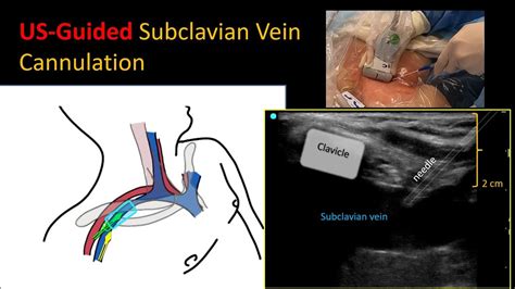 Ultrasound Guided Subclavian Vein Cannulation How I Do It Youtube