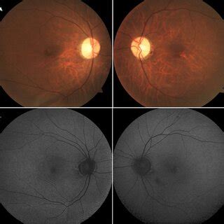 Fundus Photographs And Fundus Autofluorescence Faf Images Left