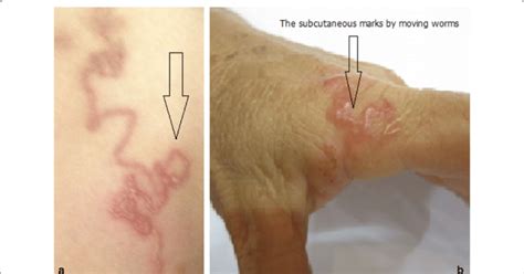 Skin Lesions Found In Vietnamese Patients Showing Two Creeping Download Scientific Diagram