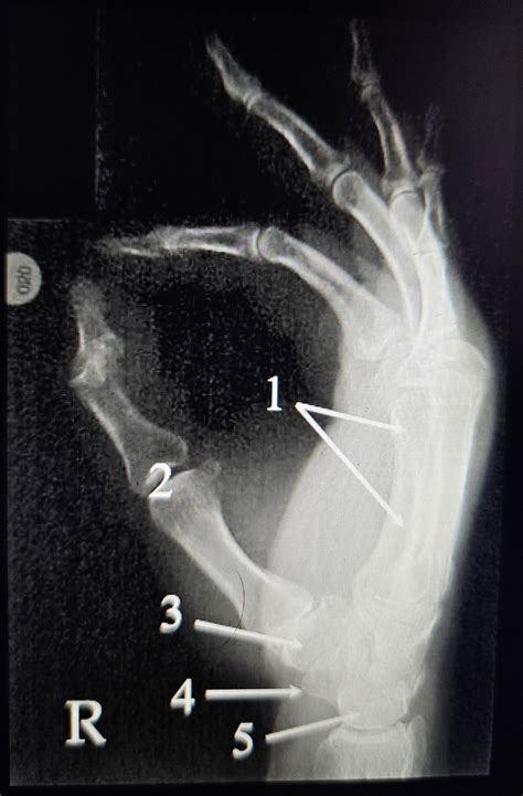 Lateral Hand Diagram Quizlet