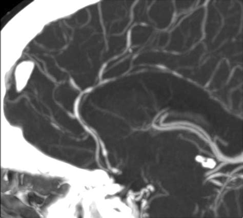 Typical Head Ct Angiogram Findings In Rcvs Download Scientific Diagram