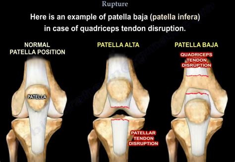 Quadriceps Tendon Rupture —