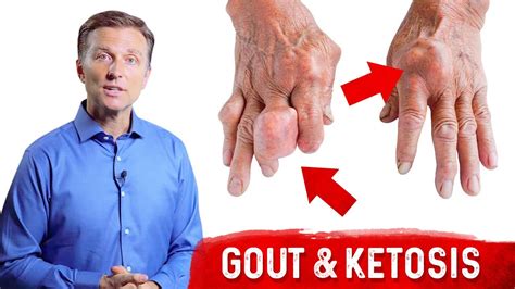 Gout And Ketosis Uric Acid Stones And High Uric Acid On Keto Dr Berg Youtube