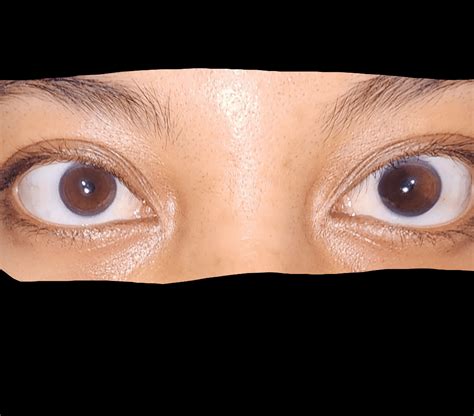 Brownbrown Sectoral Heterochromia In One Eye Rheterochromia