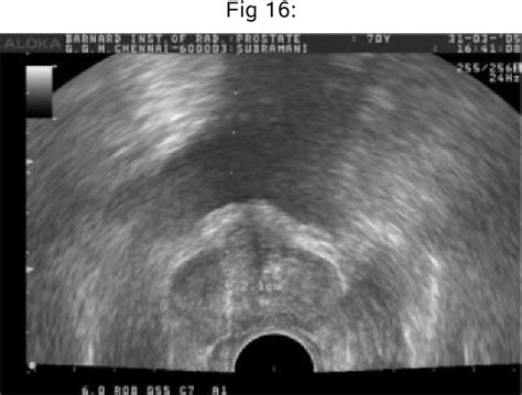 Figure From Role Of Transrectal Sonography With Colour Doppler And