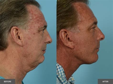 Facelift Before And After Photos Results PlasticSurgeryInsights