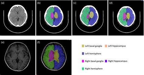 Representative Segmentation Results Of One Subject From The Independent Download Scientific