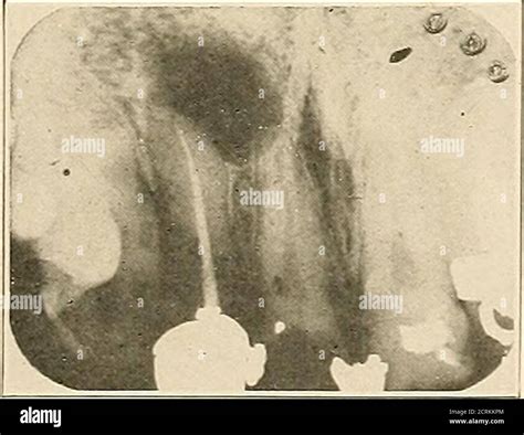 Interpretation Of Dental And Maxillary Roentgenograms Fig 216 Fig