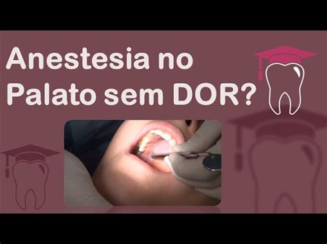 Anestesia Do Nervo Palatino Maior E Nervo Nasopalatino Odonto Up