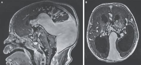 Vein Of Galen Malformation In Neonate - MEDizzy Journal