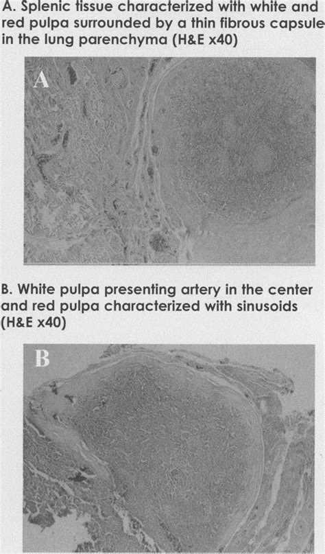 Microscopy Of Pulmonary Splenosis A Splenic Tissue Characterized With