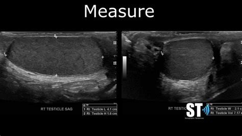 Normal Epididymis Ultrasound