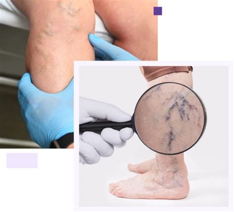 Varicose Veins Varicose Veins Surgery Cost In Coimbatore