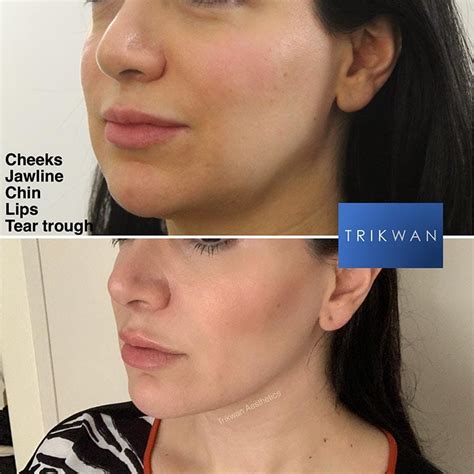 Jawline Slimming Trikwan Aesthetics Jawline Therapy Mayfair