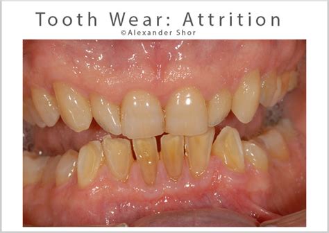 Tooth Wear Treatment Seattle - Shor Dental