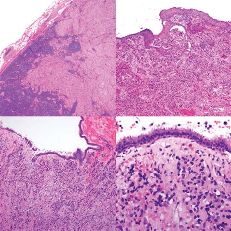 Basaloid Pattern With Nests Of Basophilic Cells With High Download