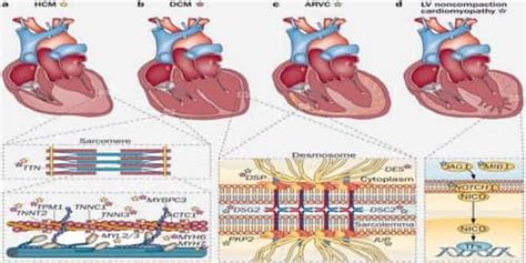 Cardiomyopathy (Types, Causes, and Risk factors) - Assignment Point