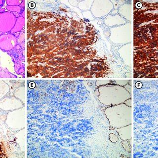 Tumor In Right Thigh Histology Reveals Merkel Cells Carcinoma