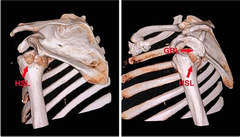 ‘bipolar Lesion Of Gbl And Hsl Demonstrated By 3 Dimensionally Download Scientific Diagram