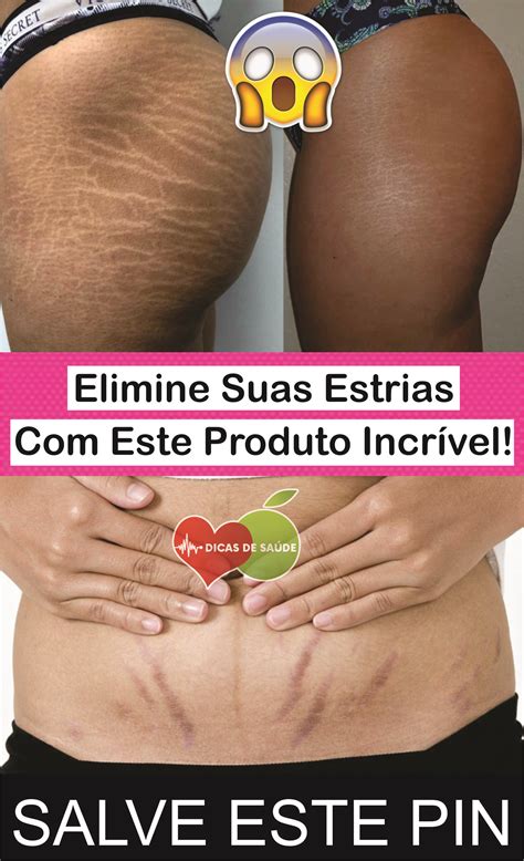 Elimine Suas Estrias Este Produto Incrível estrias