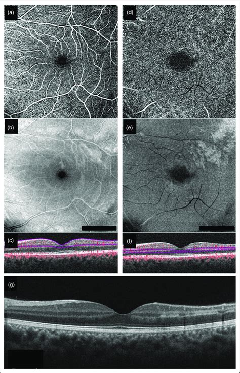 Structural Optical Coherence Tomography OCT And OCT Angiography