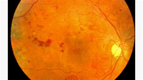 What Is Neovascularization In Diabetes Retinopathy