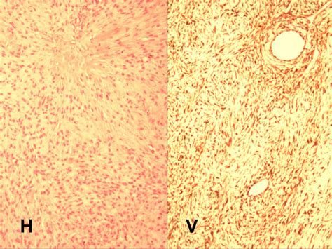 Microscopic Features Of Ovarian Fibrothecoma Include Round And Spindle