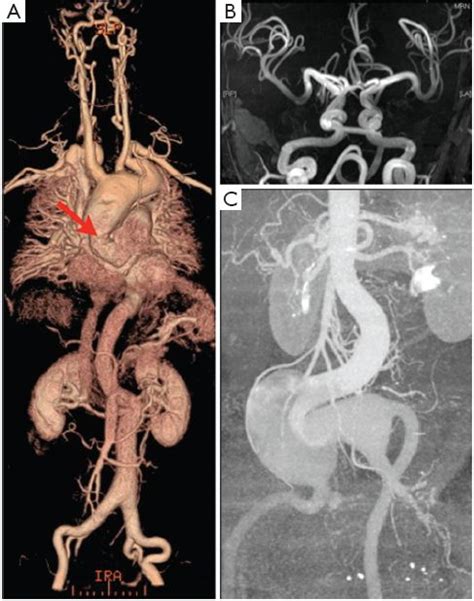 Genes In Thoracic Aortic Aneurysms Dissections Do They Matter De