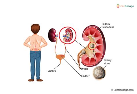 What is a kidney stone? Symptoms, Cause, Treatments and Prevention