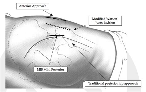 Approaches To The Hip