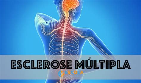 Fisiologia Da Esclerose Multipla BRAINCP