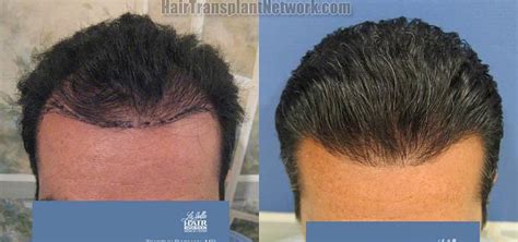 Dr Timothy Carman Hair Restoration Surgery Before And After Result