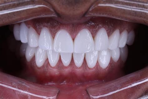 Composite Resin Veneers Dental Design Smile Miami