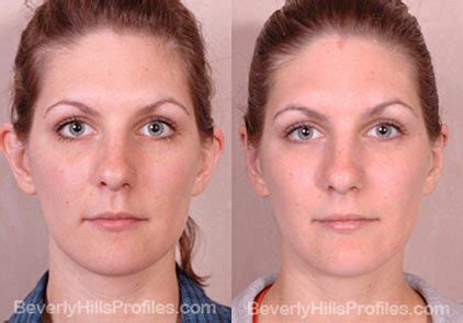 Otoplasty Ear Surgery Beverly Hills Profiles Los Angeles